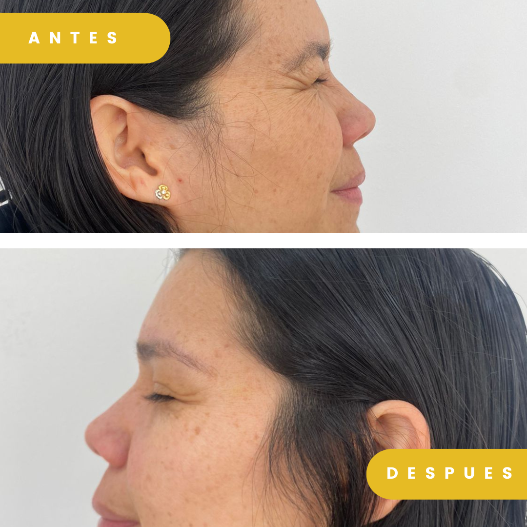 Botox rejuvenecimiento facial patas de gallina