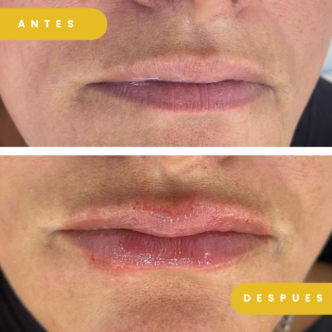 perfilamiento y relleno de labios